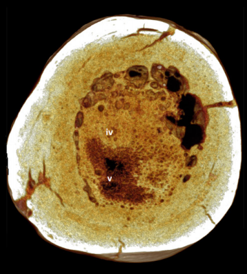 A cut-away of the bone. The spongy tumor is designated as (v). (Image: Edward J. Odes et al., 2016)